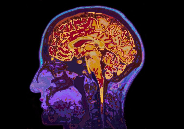 Farbiges MRT-Bild eines menschlichen Gehirns – Symbolfoto für die Fortbildung „Kriegsschauplatz Gehirn“